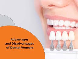 Advantages of Dental Veneers' for Discolored or Crooked Teeth